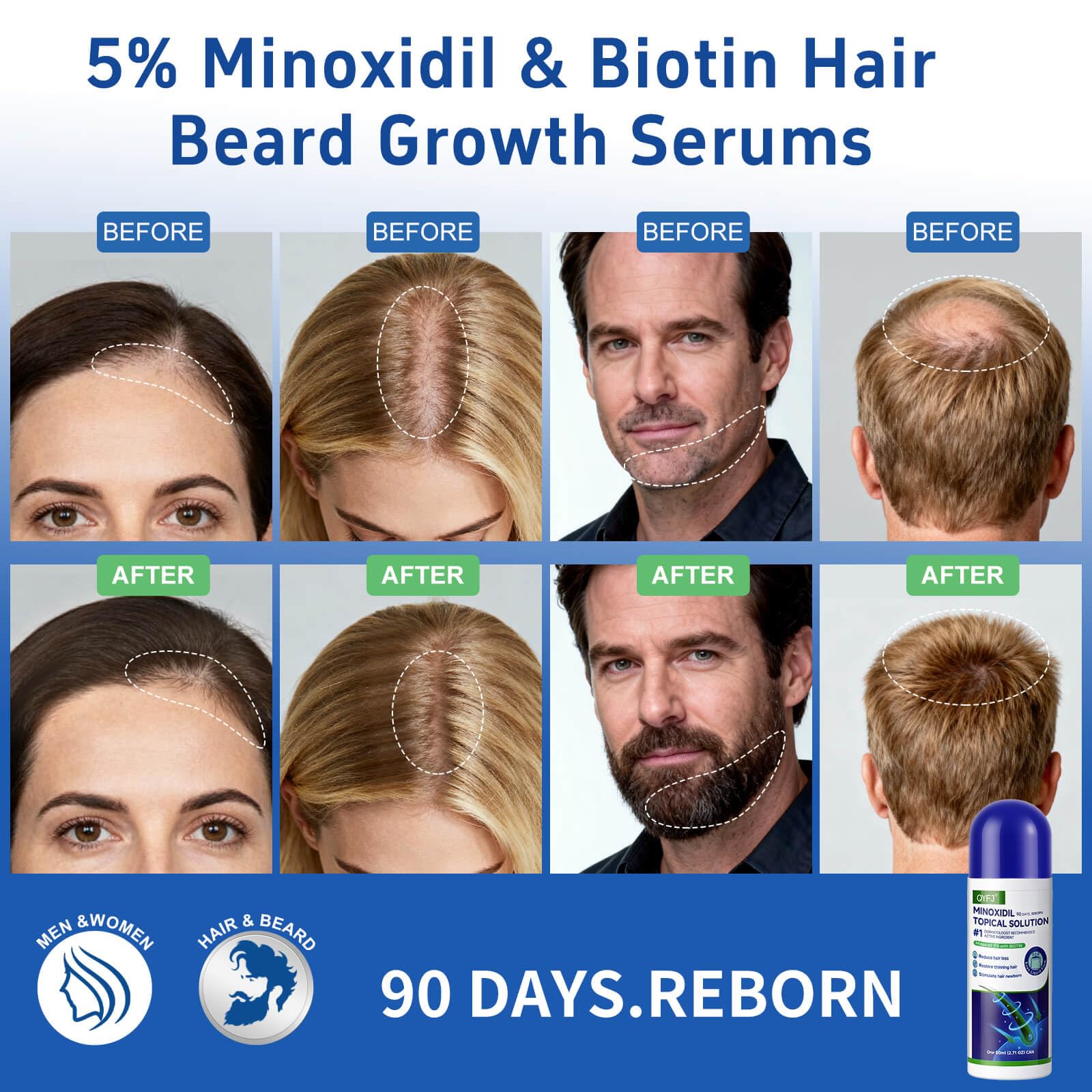 QYFJ minoxidil serum bottle front view for consistent use.