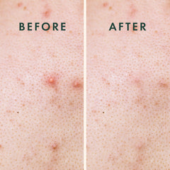 Rael Miracle XL patch shows 50mm by 50mm coverage on skin.