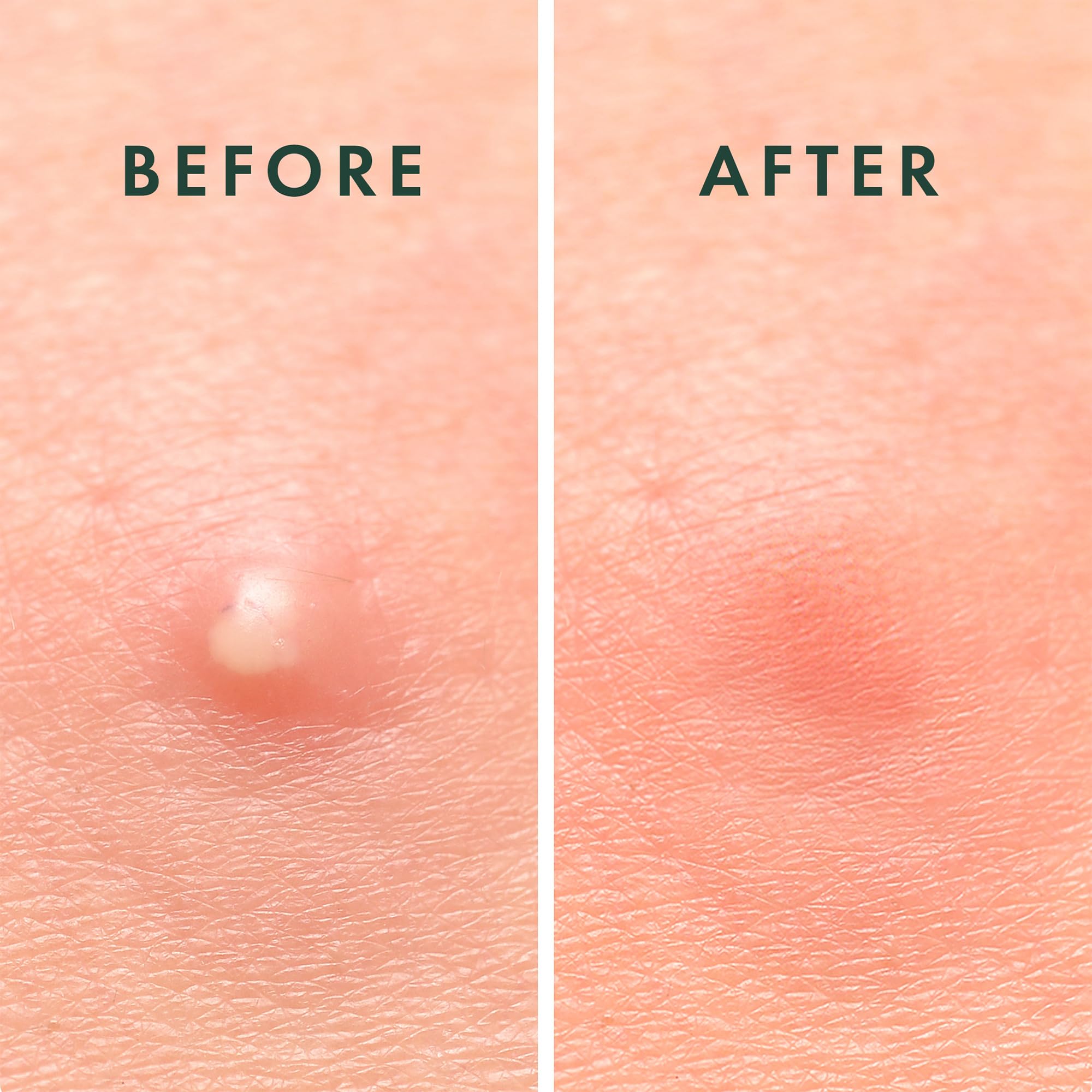 Rael pimple patch long-wear on skin demonstrates secure adhesion.