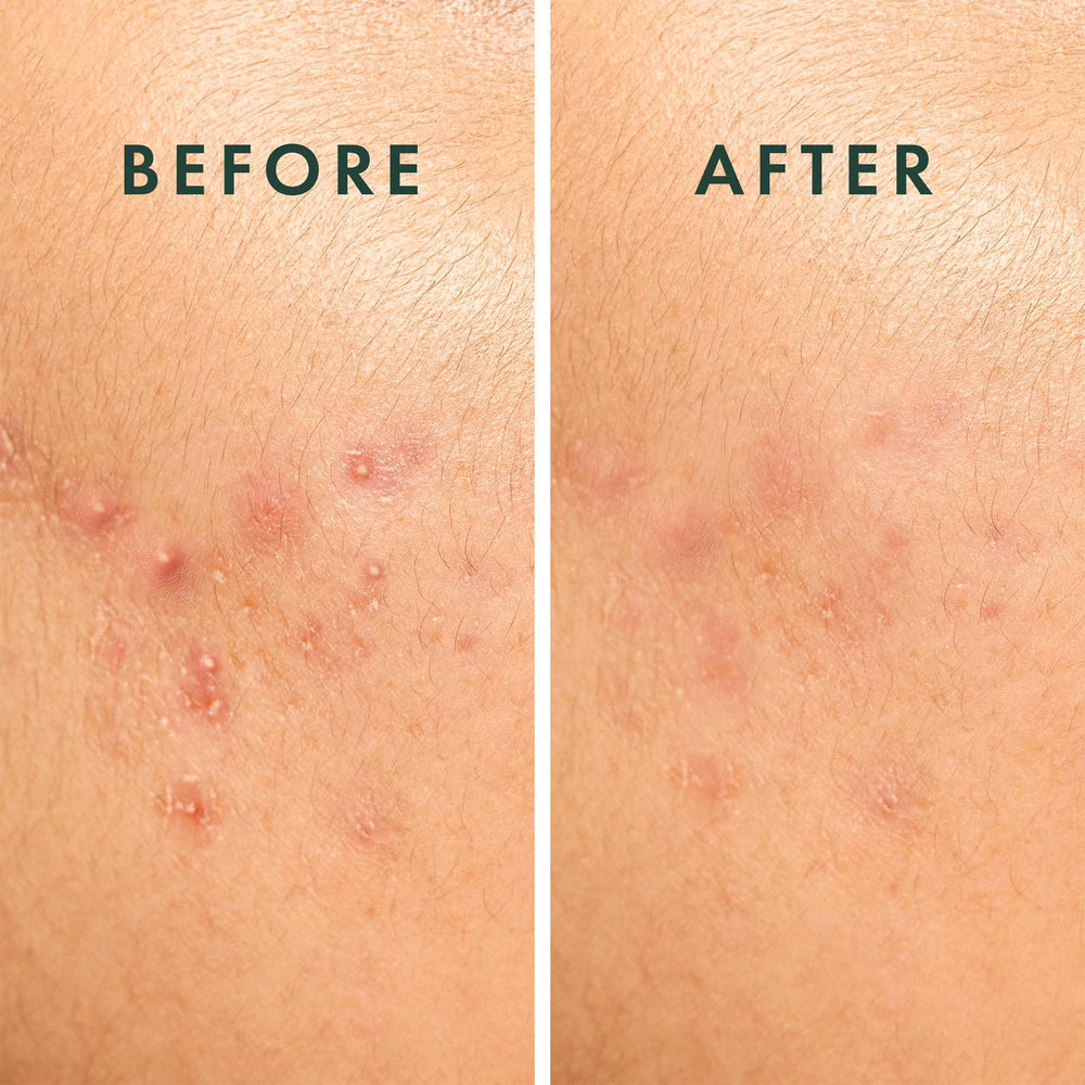 Rael pimple patches application-ready-packaging enables quick, clean application.