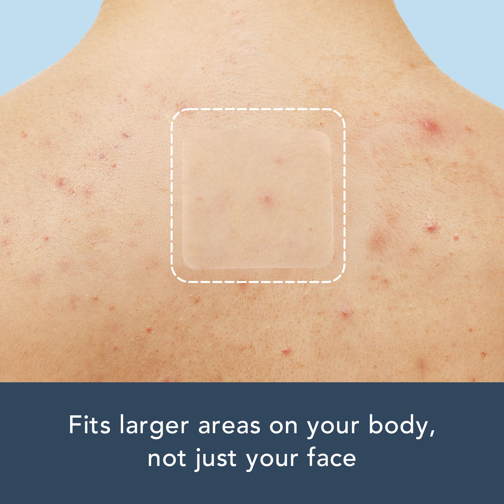 Rael patch applied to back illustrating suitability for body acne.
