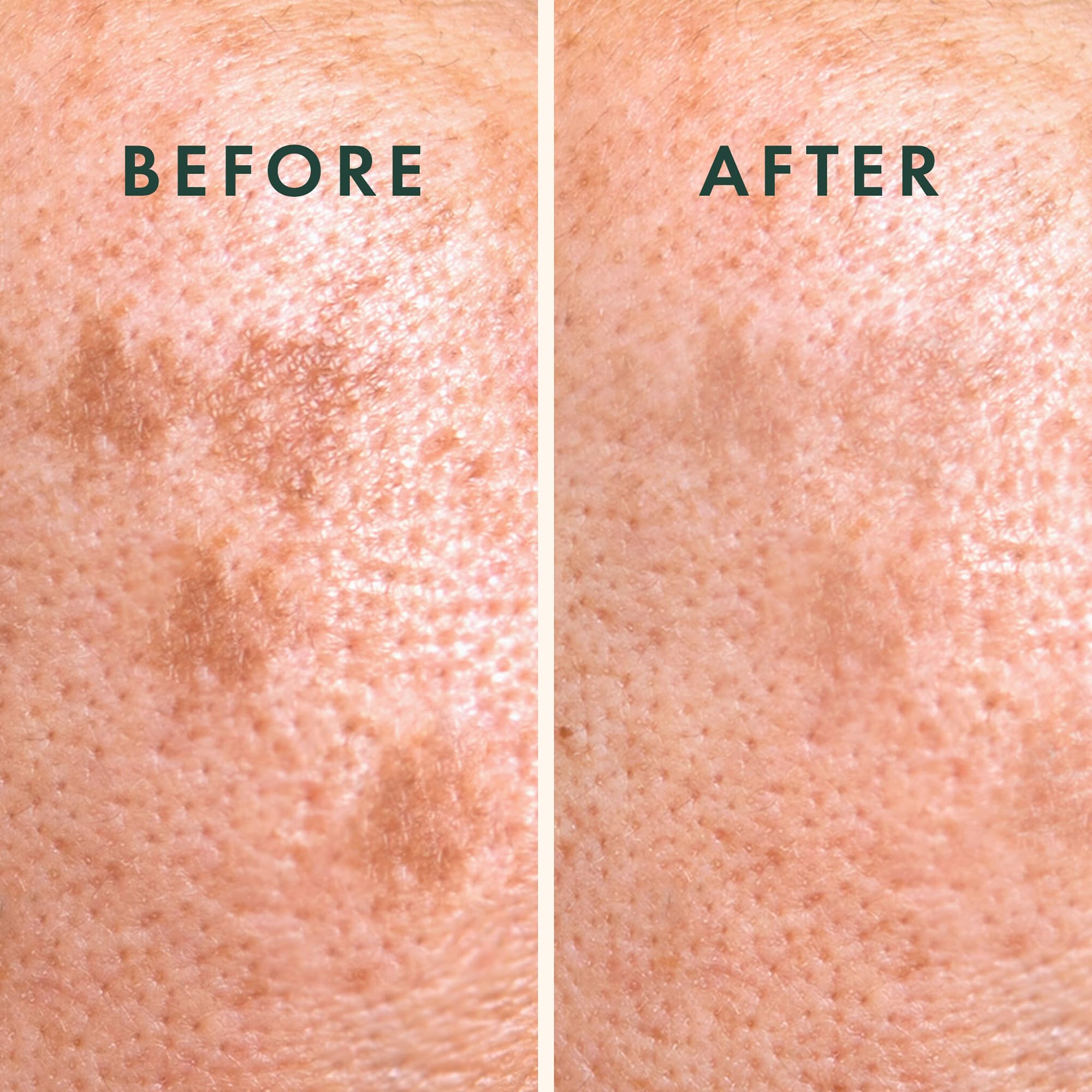 Rael hydrocolloid layer close-up reveals protective patch for blemish coverage.