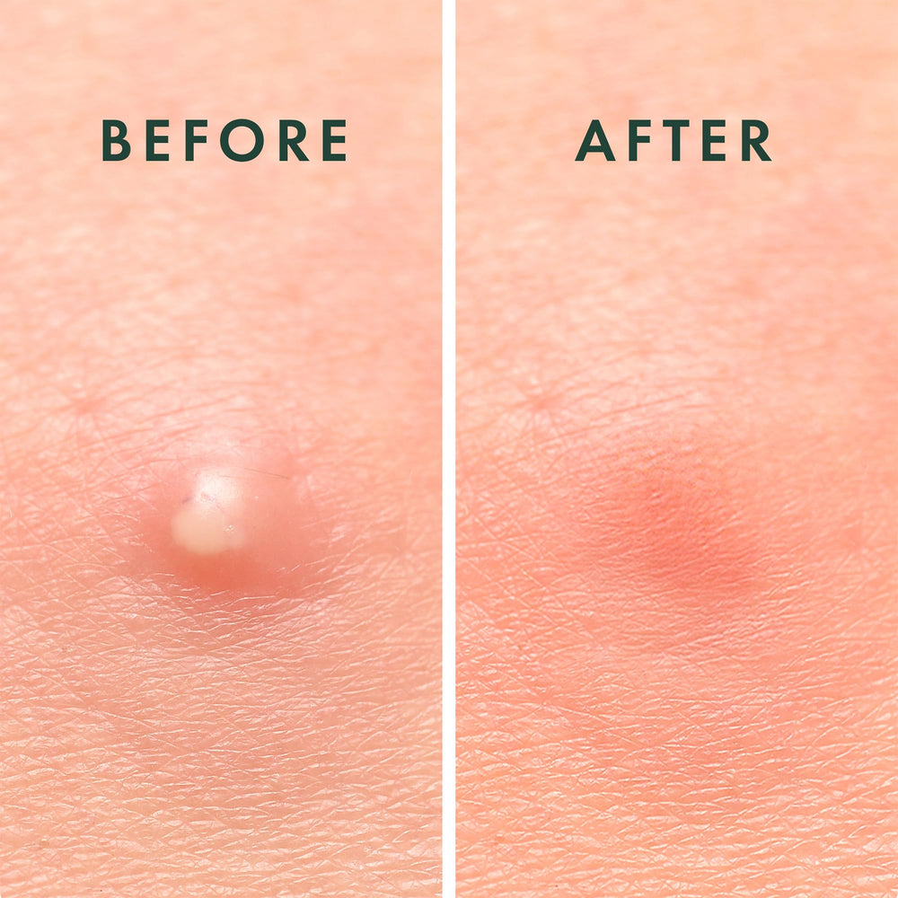Rael Pimple Patches shown against diverse skin tones blending naturally.