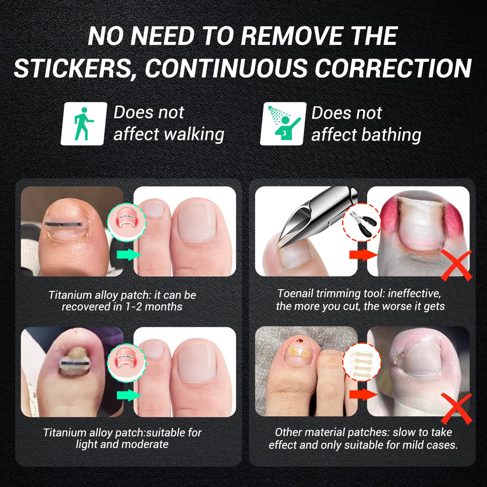 Reieset curved nail repair process in use suggests gradual nail shaping over weeks.