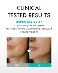 REJURAN dual-sheet lifting design targets face and jawline for firmer contours