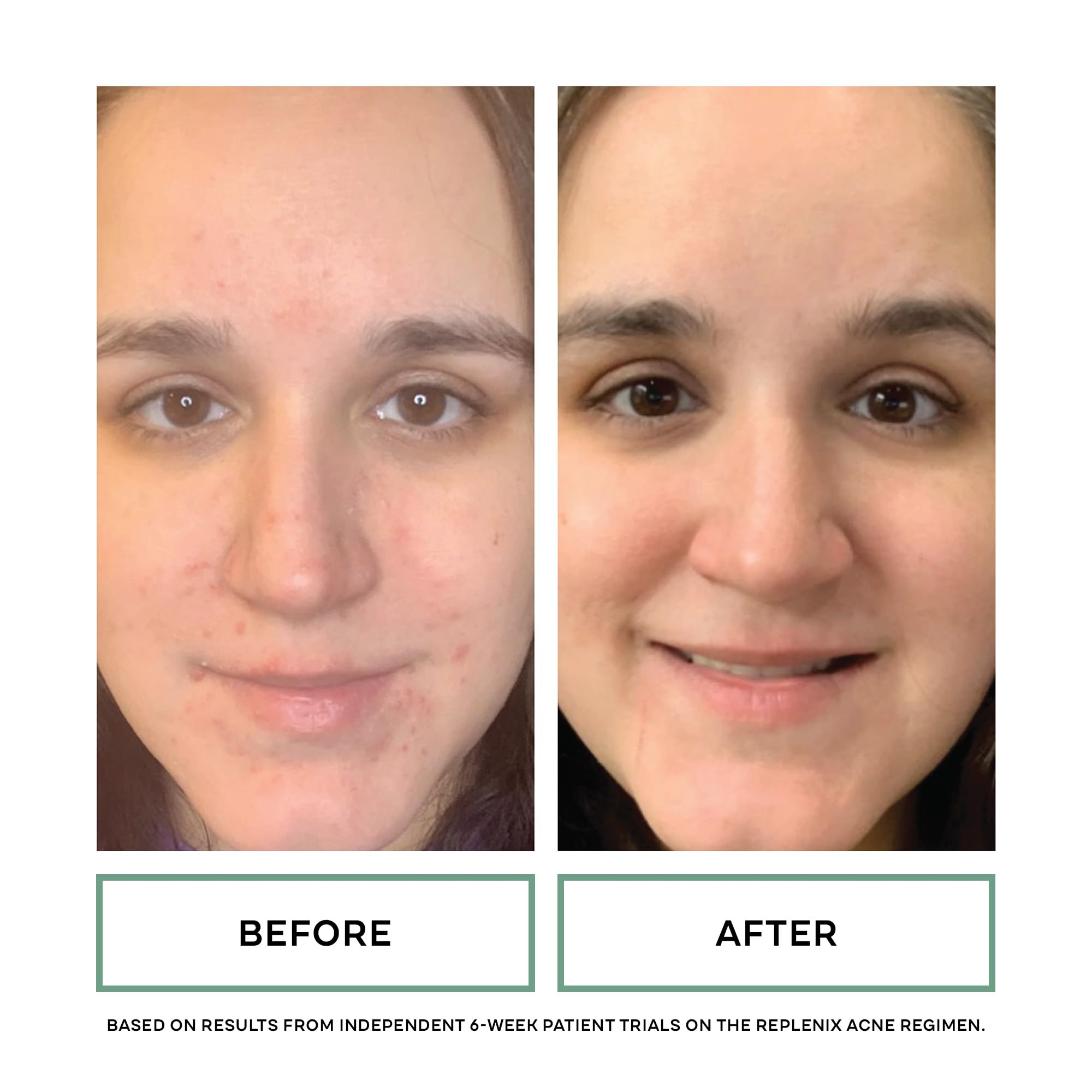 Replenix BP Acne Face Wash skin-closeup suggests refined pores and refreshed appearance.