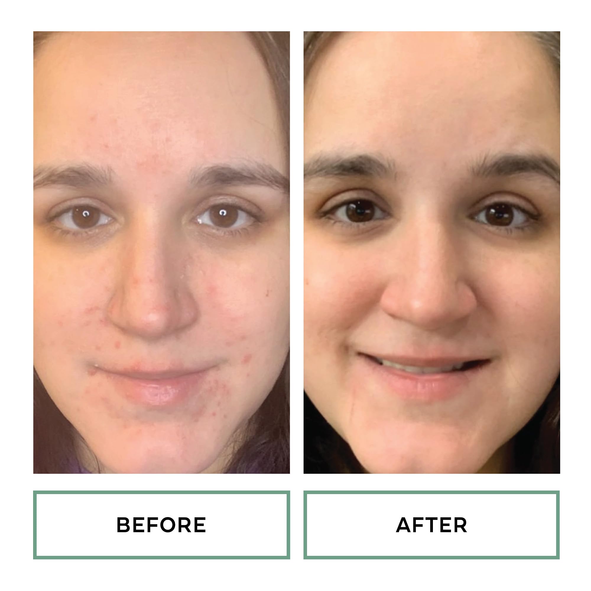 Replenix Gly-Sal Clarifying Acne Pads witch hazel soothing touch during use.