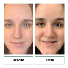 Replenix Gly-Sal Clarifying Acne Pads witch hazel soothing touch during use.