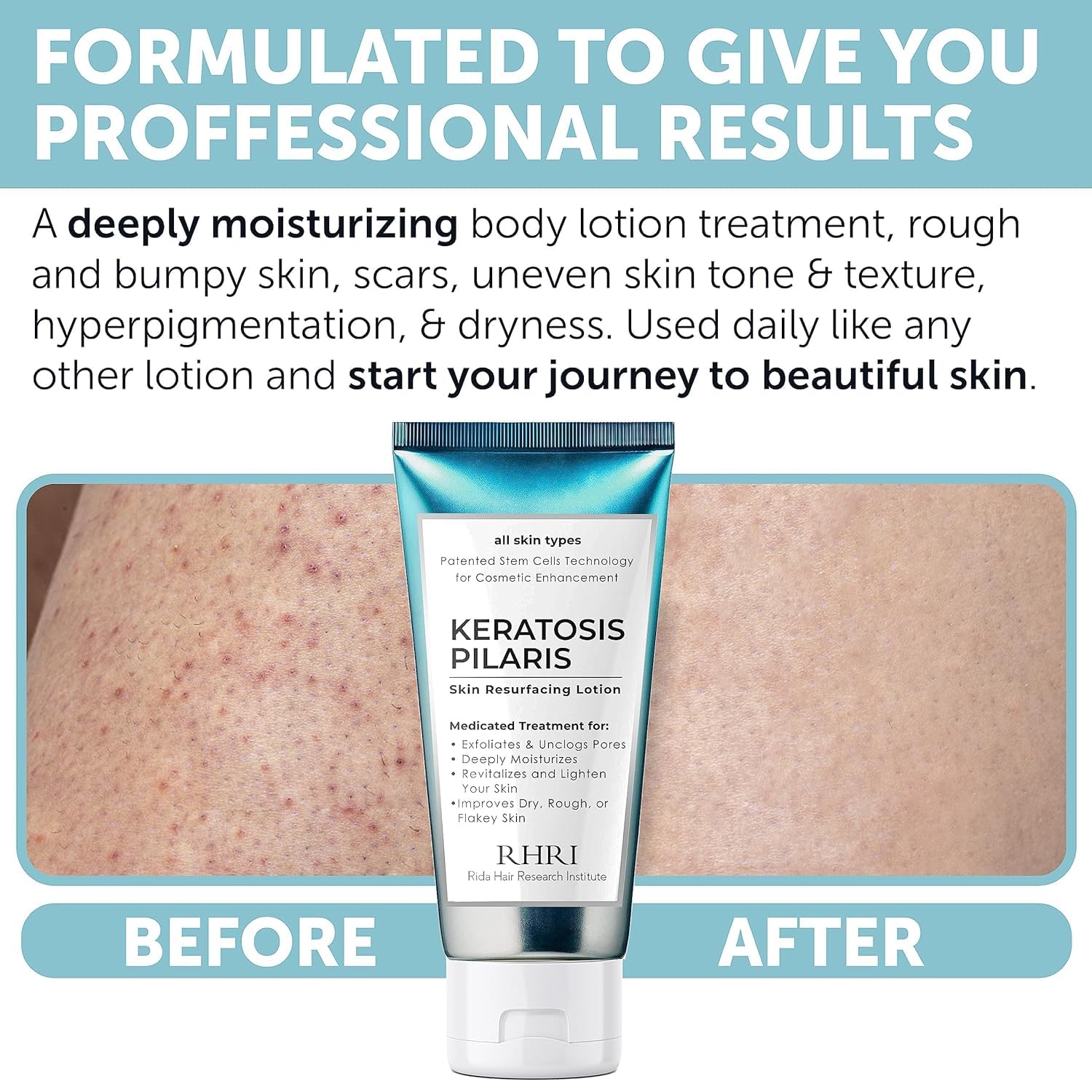 Hands applying Rida KP Bump Eraser on arm for smoother skin.