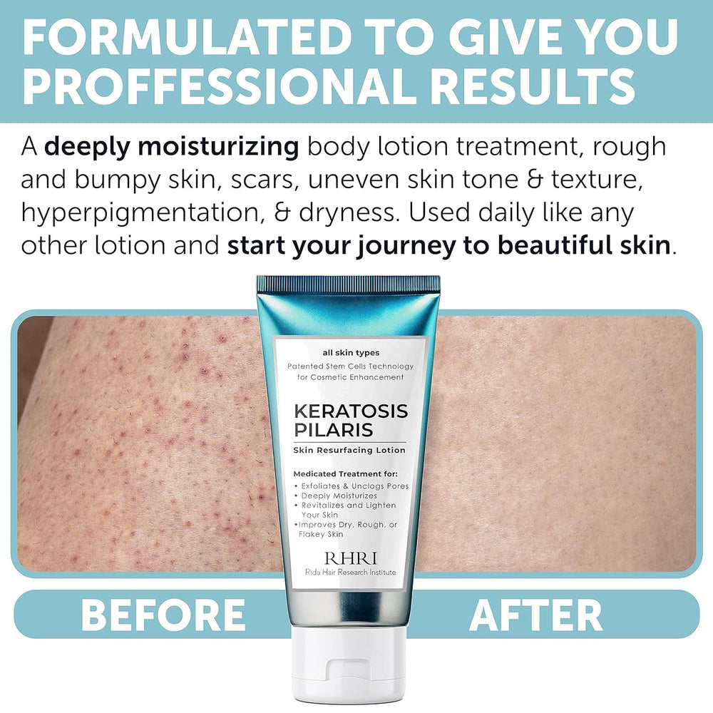 Hands applying Rida KP Bump Eraser on arm for smoother skin.