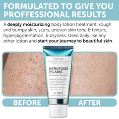 Hands applying Rida KP Bump Eraser on arm for smoother skin.