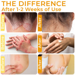 Rida Hair Research Institute psoriasis cream on skin showing comfort and calm