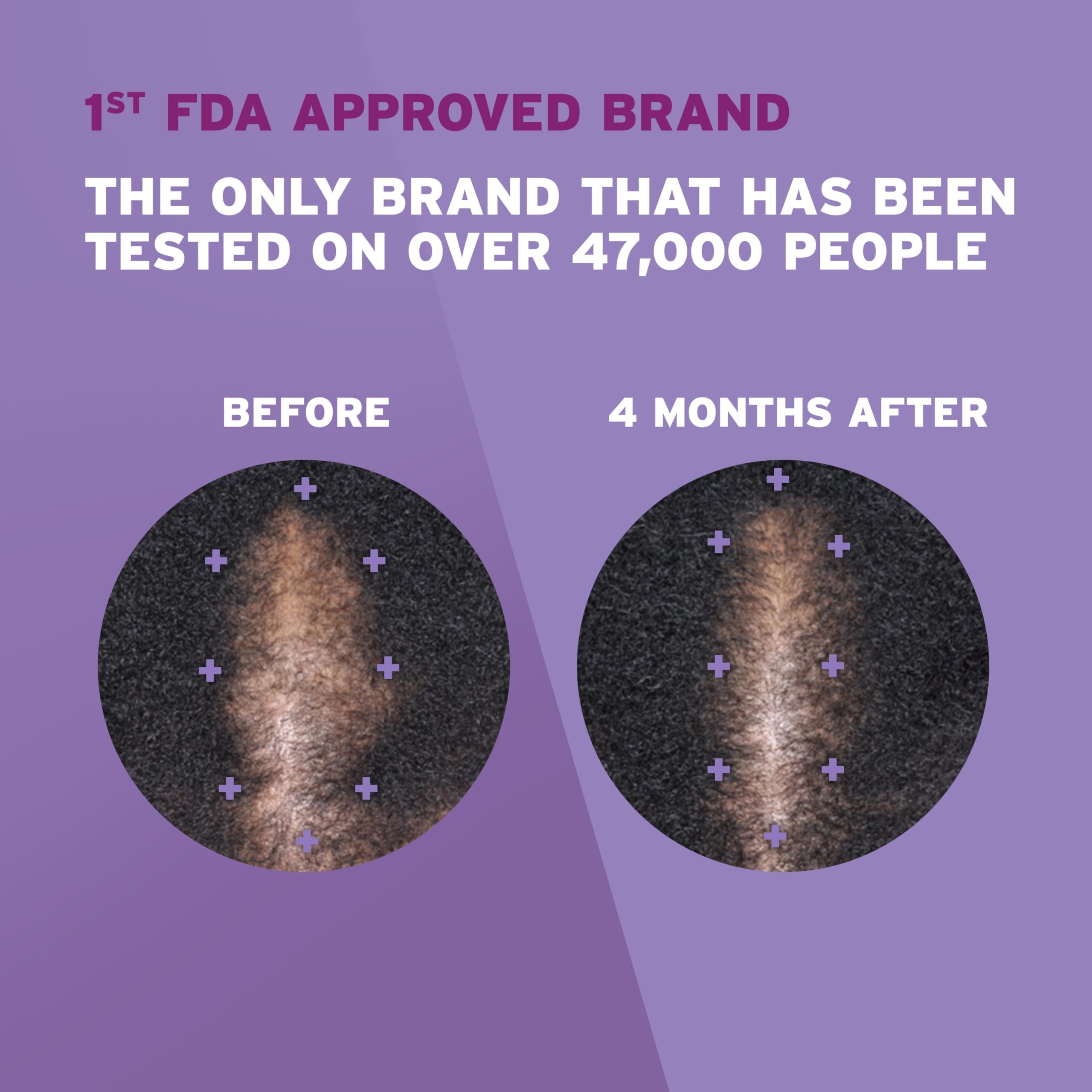 Rogaine foam being applied to scalp demonstrating precise targeted use