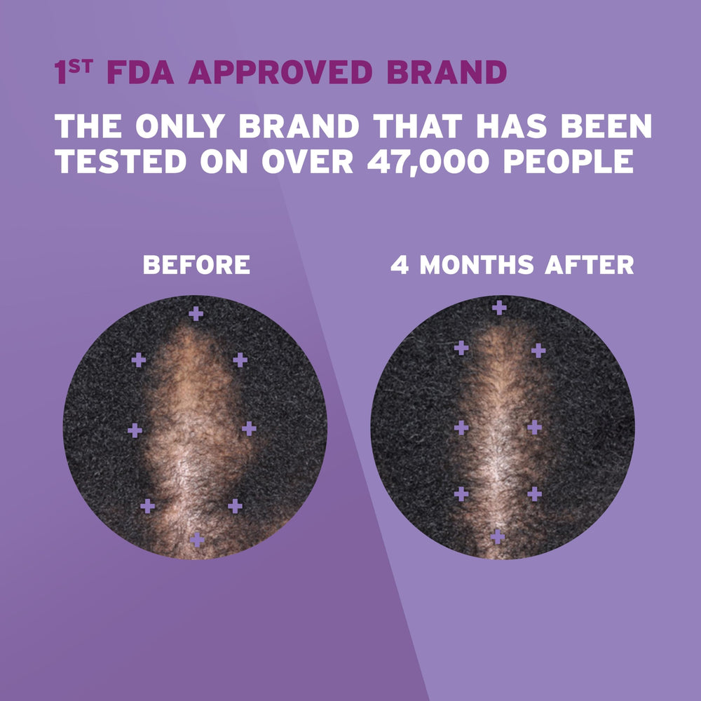 Rogaine foam being applied to scalp demonstrating precise targeted use