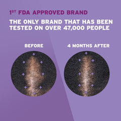 Rogaine foam being applied to scalp demonstrating precise targeted use