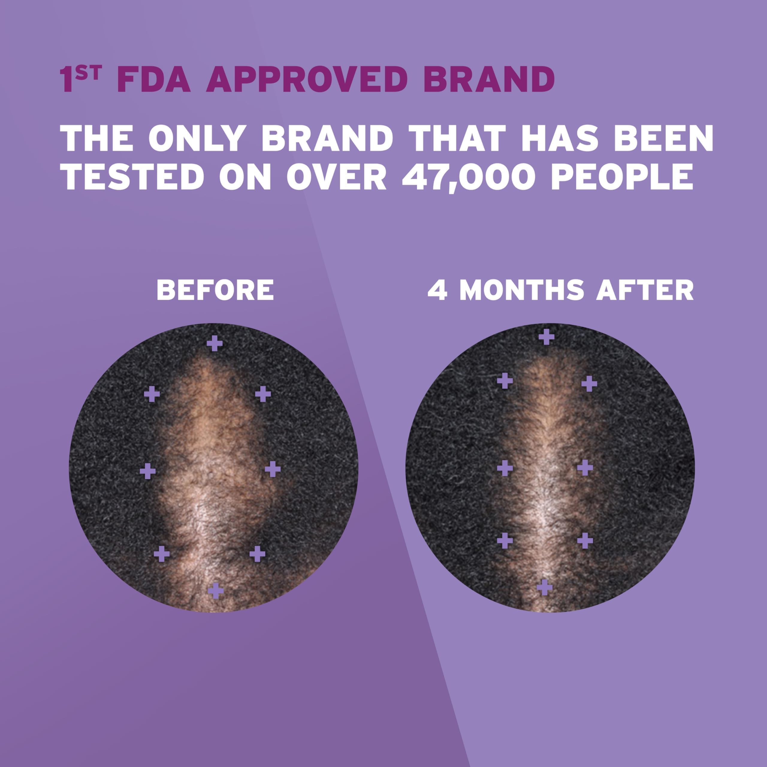 Rogaine foam being applied to scalp demonstrating targeted coverage