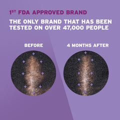 Rogaine foam being applied to scalp demonstrating targeted coverage