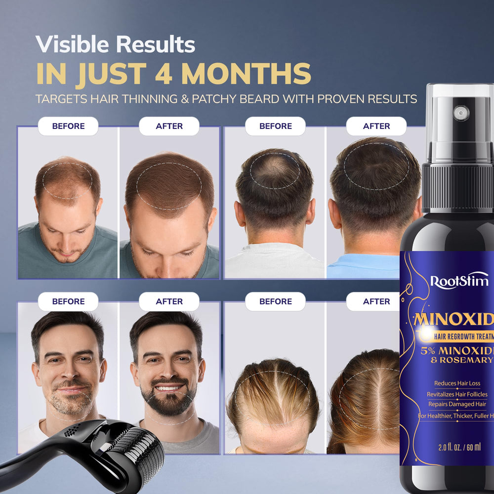 RootStim derma roller for scalp care used alongside spray