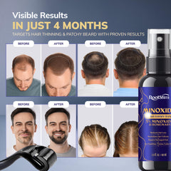 RootStim derma roller for scalp care used alongside spray