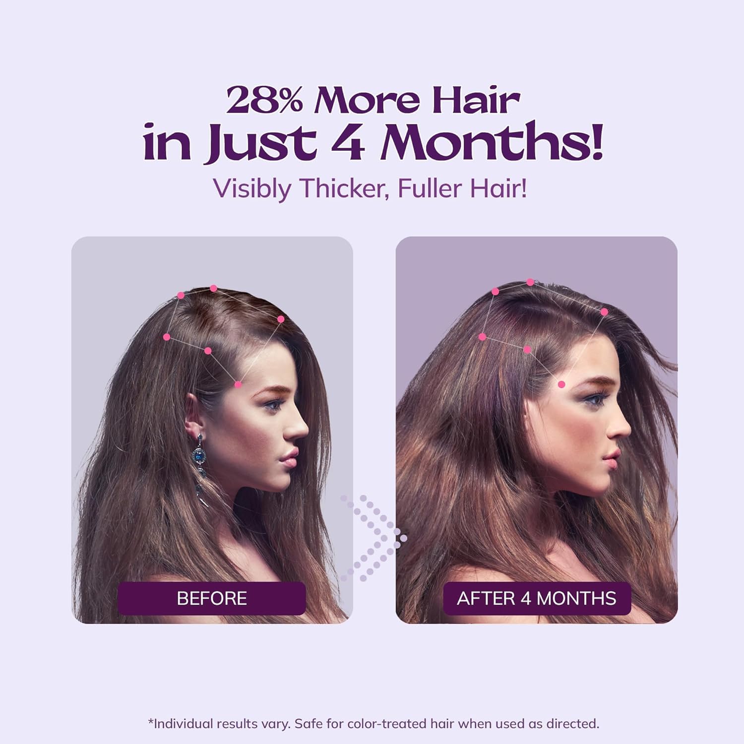 RootStim 5% Minoxidil for Women spray supports thinning area coverage with easy application.