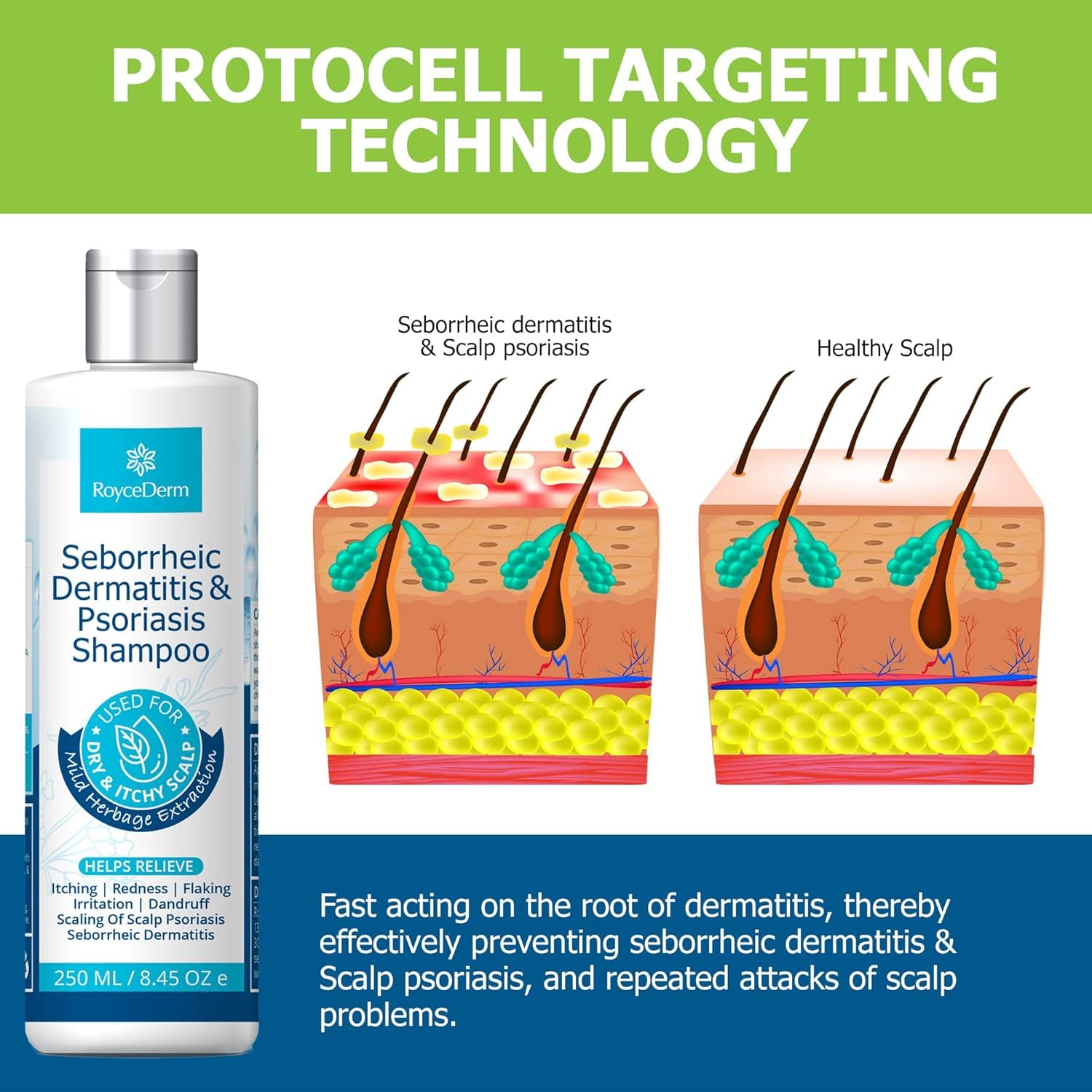 Roycederm Dandruff Shampoo bottle shows easy daily scalp cleansing