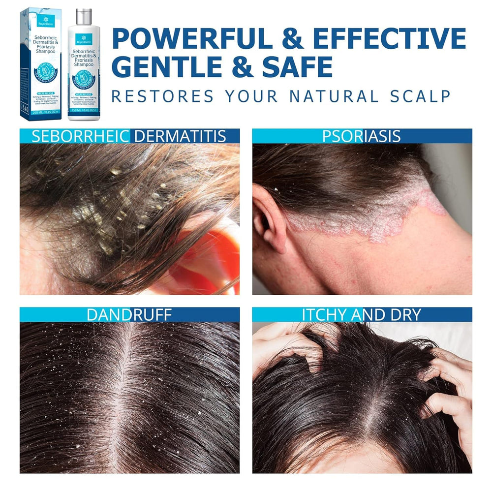 Roycederm Scalp Treatment Jar highlights moisturizing care for dry scalp