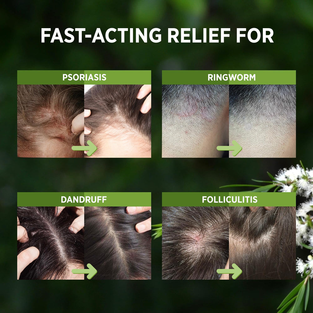 Roycederm Tea Tree cooling sensation shows immediate comfort during use.