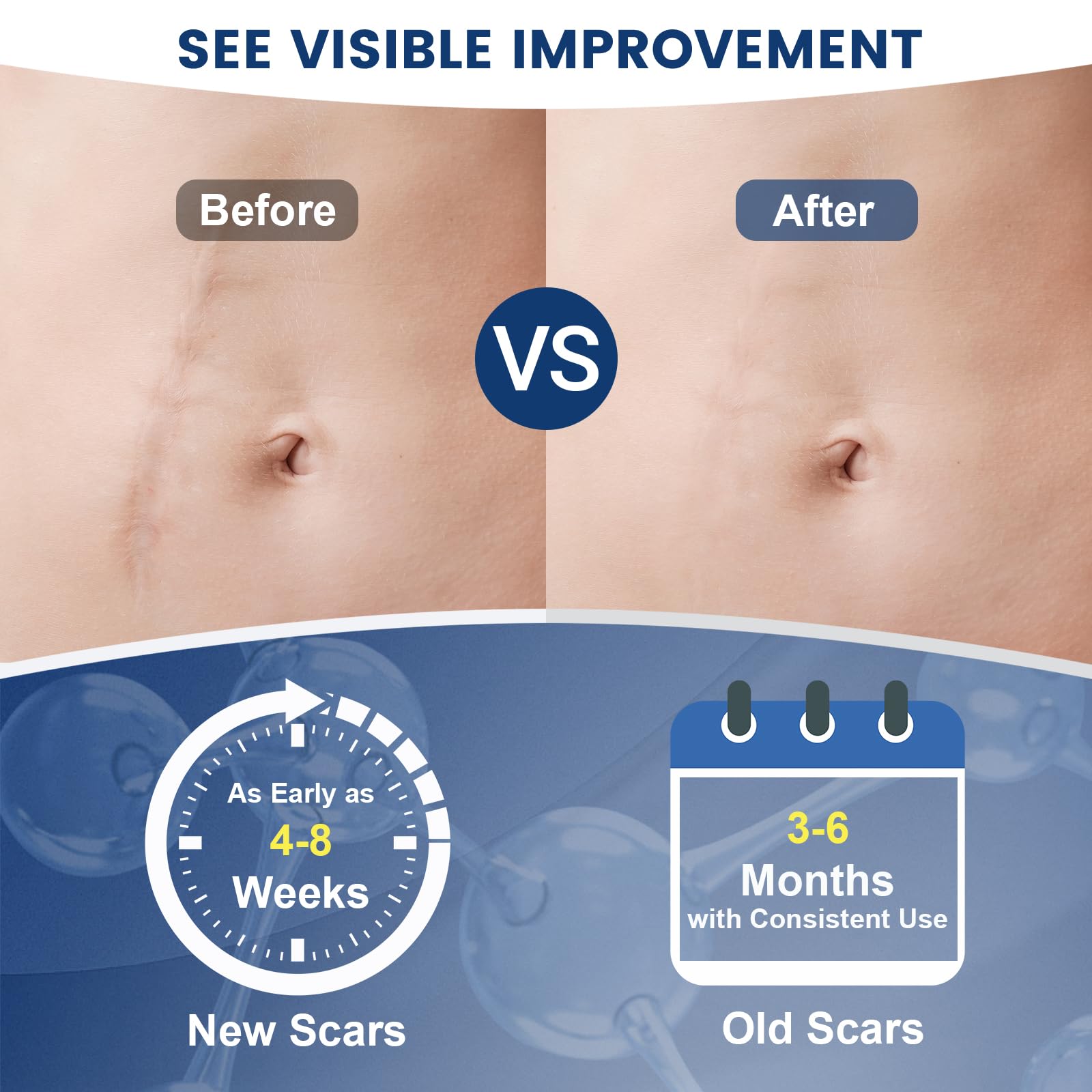 Rvlaim scar gel on burn scar area illustrating versatile scar care usage.