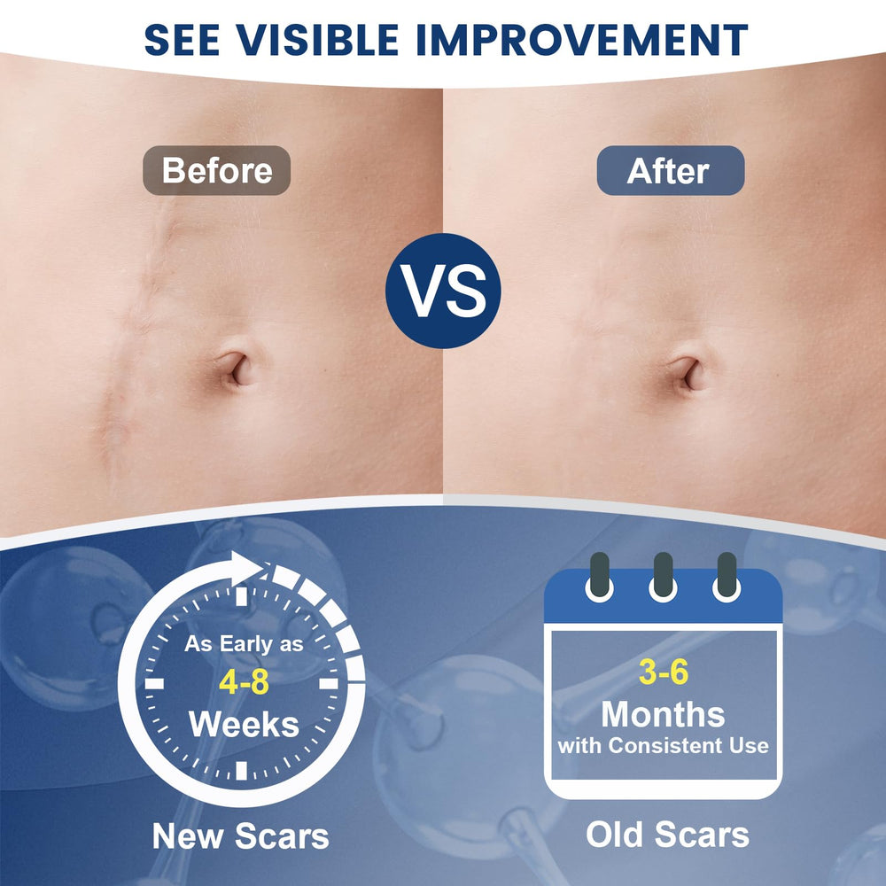 Rvlaim scar gel on burn scar area illustrating versatile scar care usage.