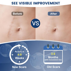 Rvlaim scar gel on burn scar area illustrating versatile scar care usage.