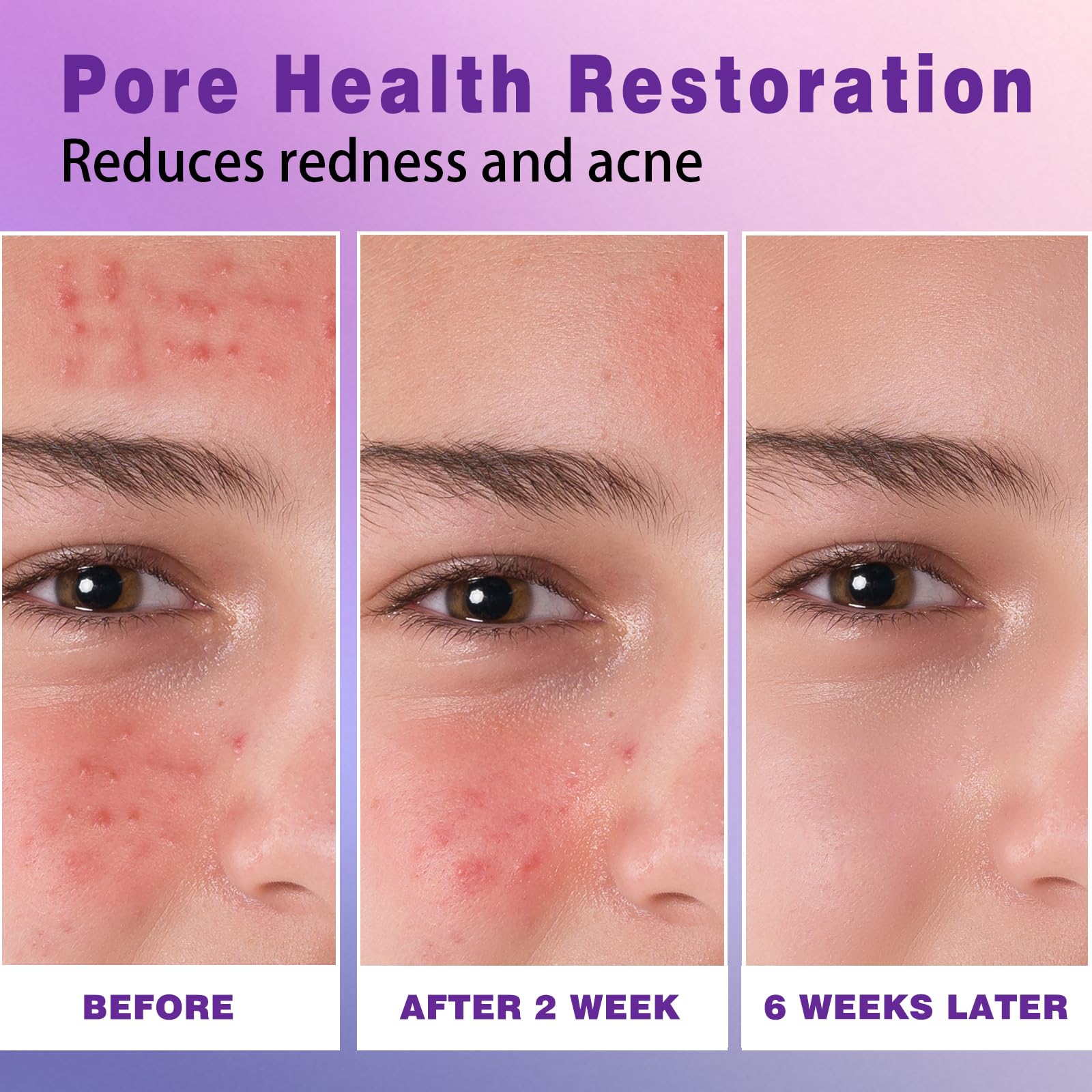 Sefralls azelaic acid cream bottle on counter implies simple redness-relief routine.