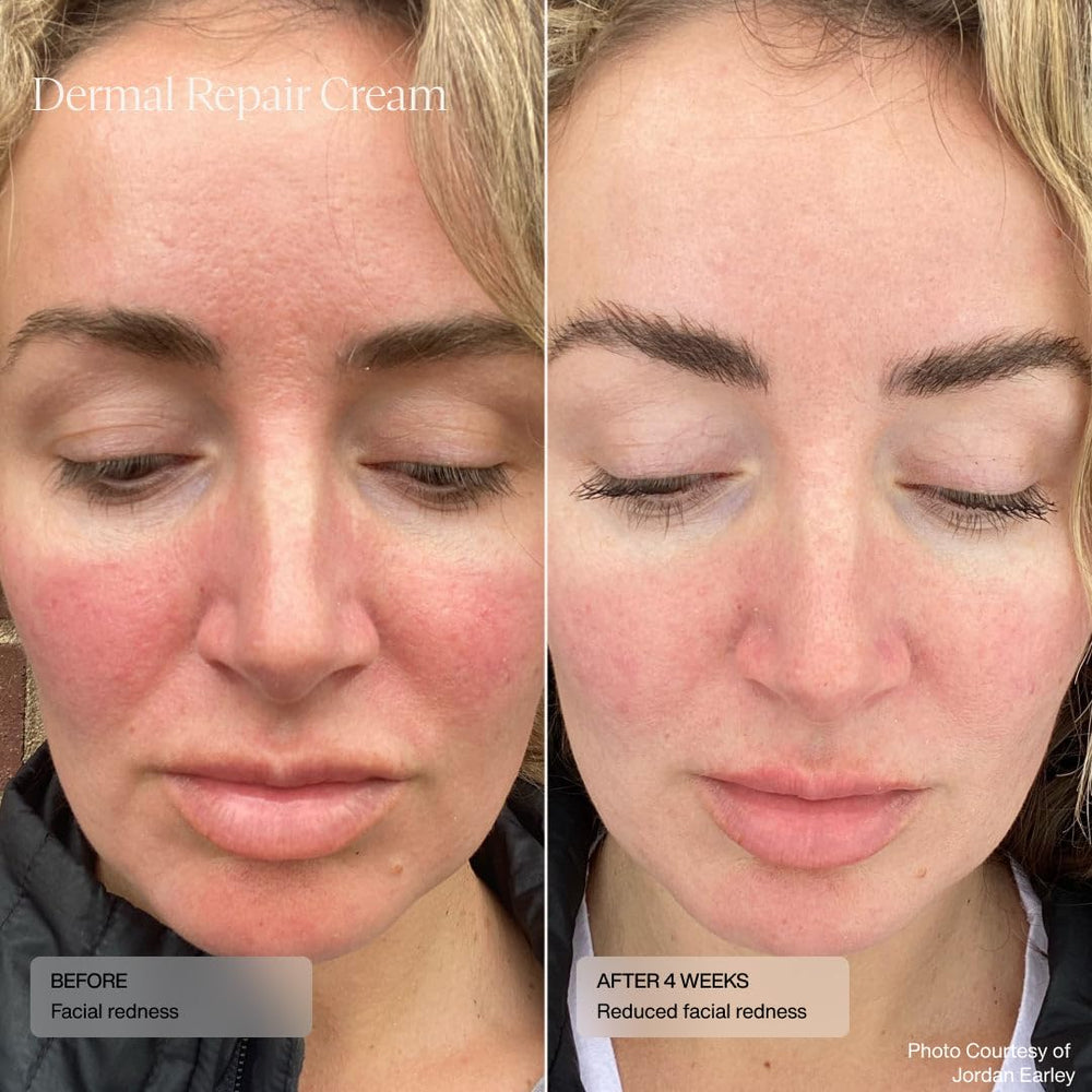 Senté packaging highlights National Rosacea Society acceptance and dermatologist-tested safety.