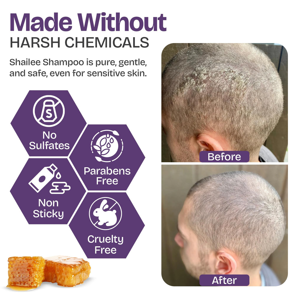 Shailee Psoriasis Shampoo foamy lather highlights gentle cleansing for itchy scalp