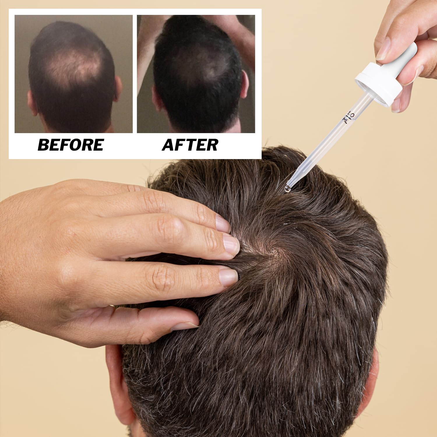 Shapiro MD Regrowth Kit packaging displaying complete hair thinning solution