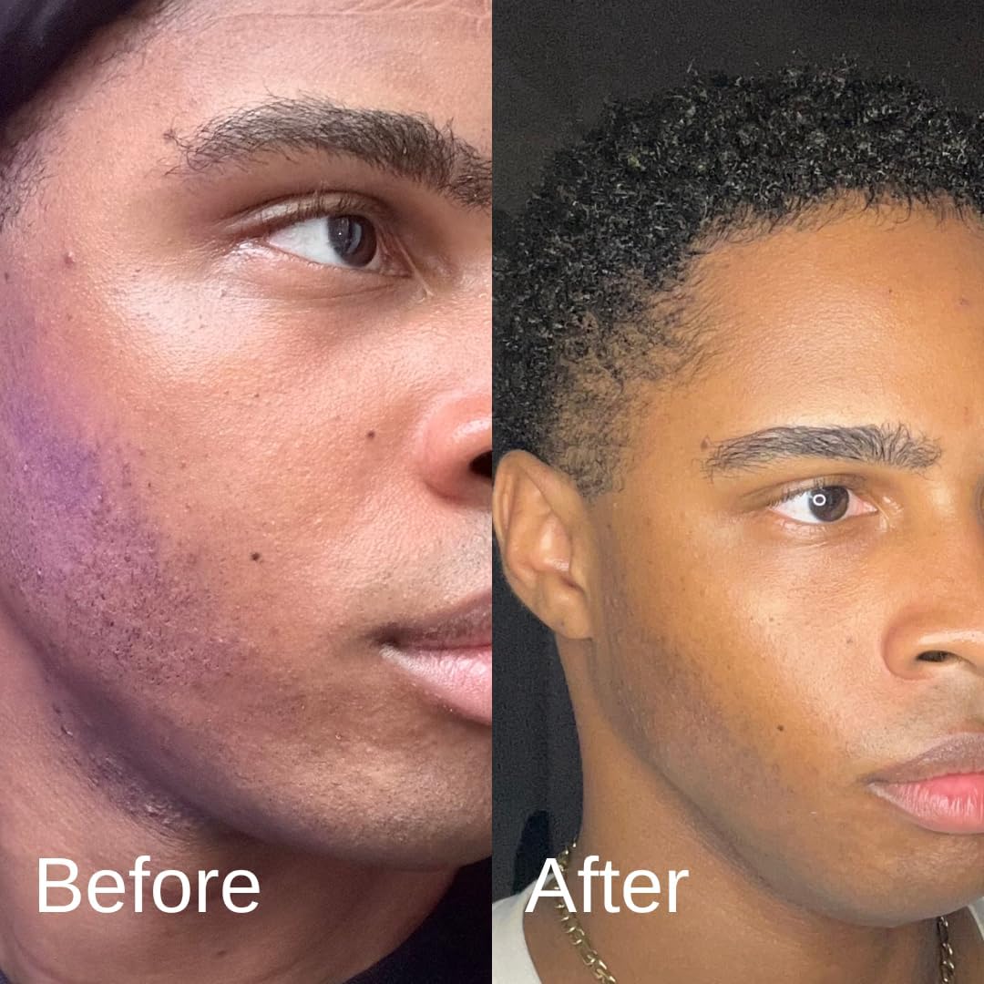 Shield blemish patches closeup illustrates targeted, invisible acne treatment.