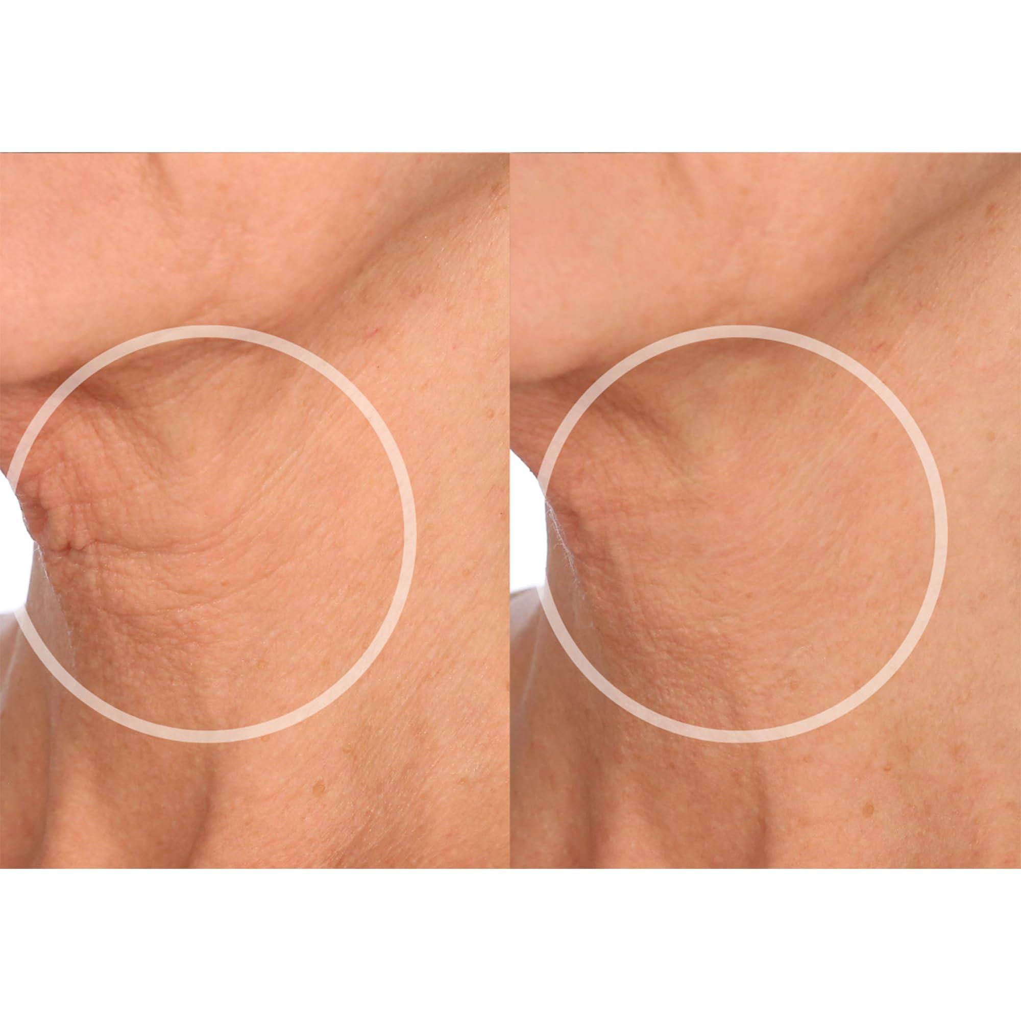 SiO Beauty FaceLift patches on neck illustrating coverage for a firmer neckline.