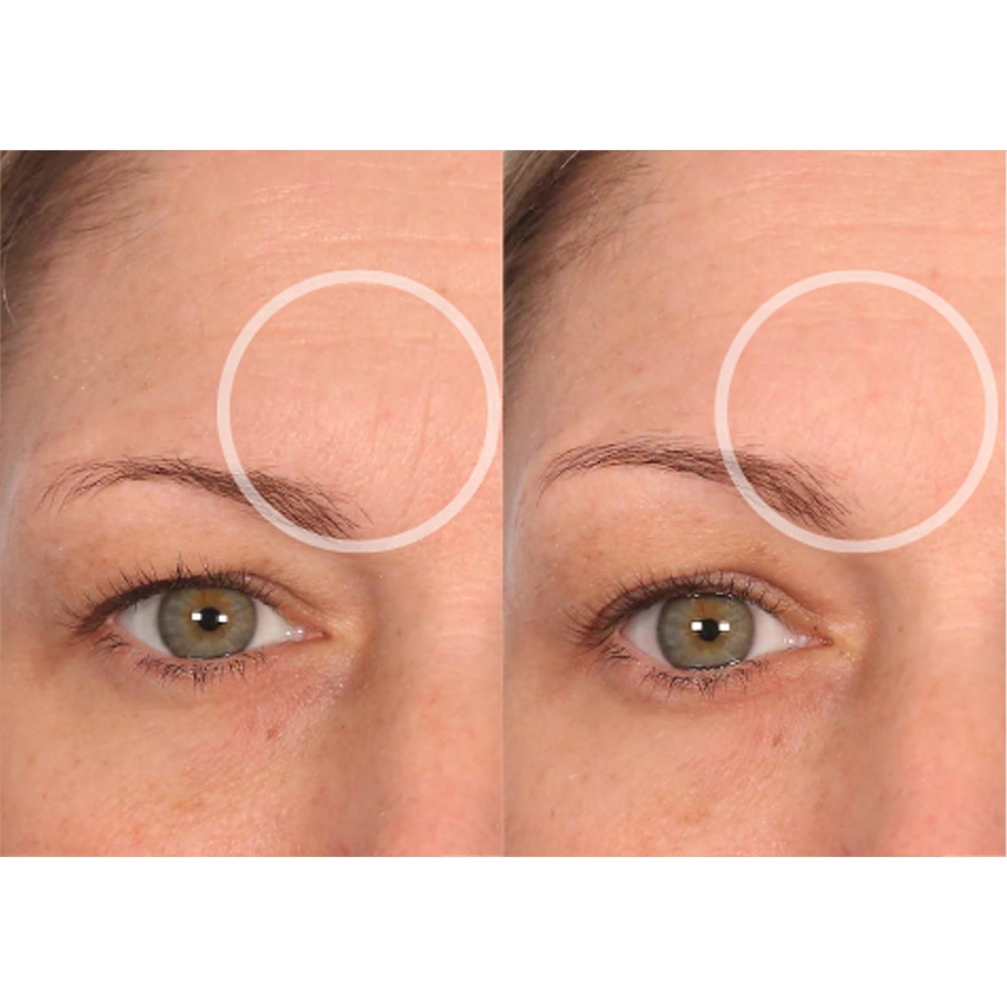 SiO Beauty FaceLift patches around mouth reduce fine lines along smile lines.