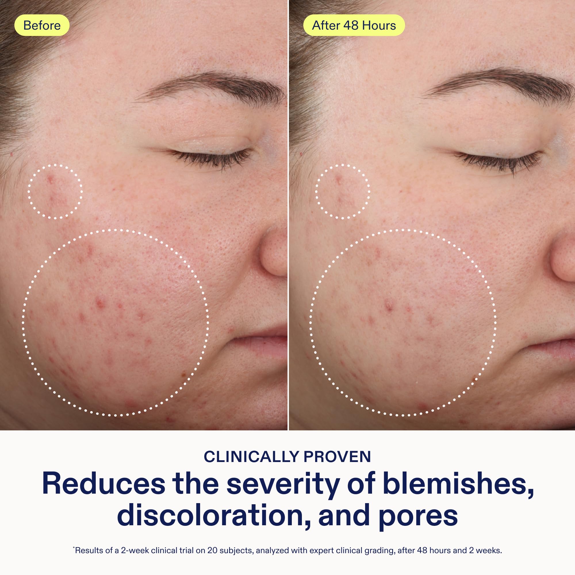 Skinfix 2% BHA Cleanser foaming-lather shows deep cleanse for oily breakout areas.