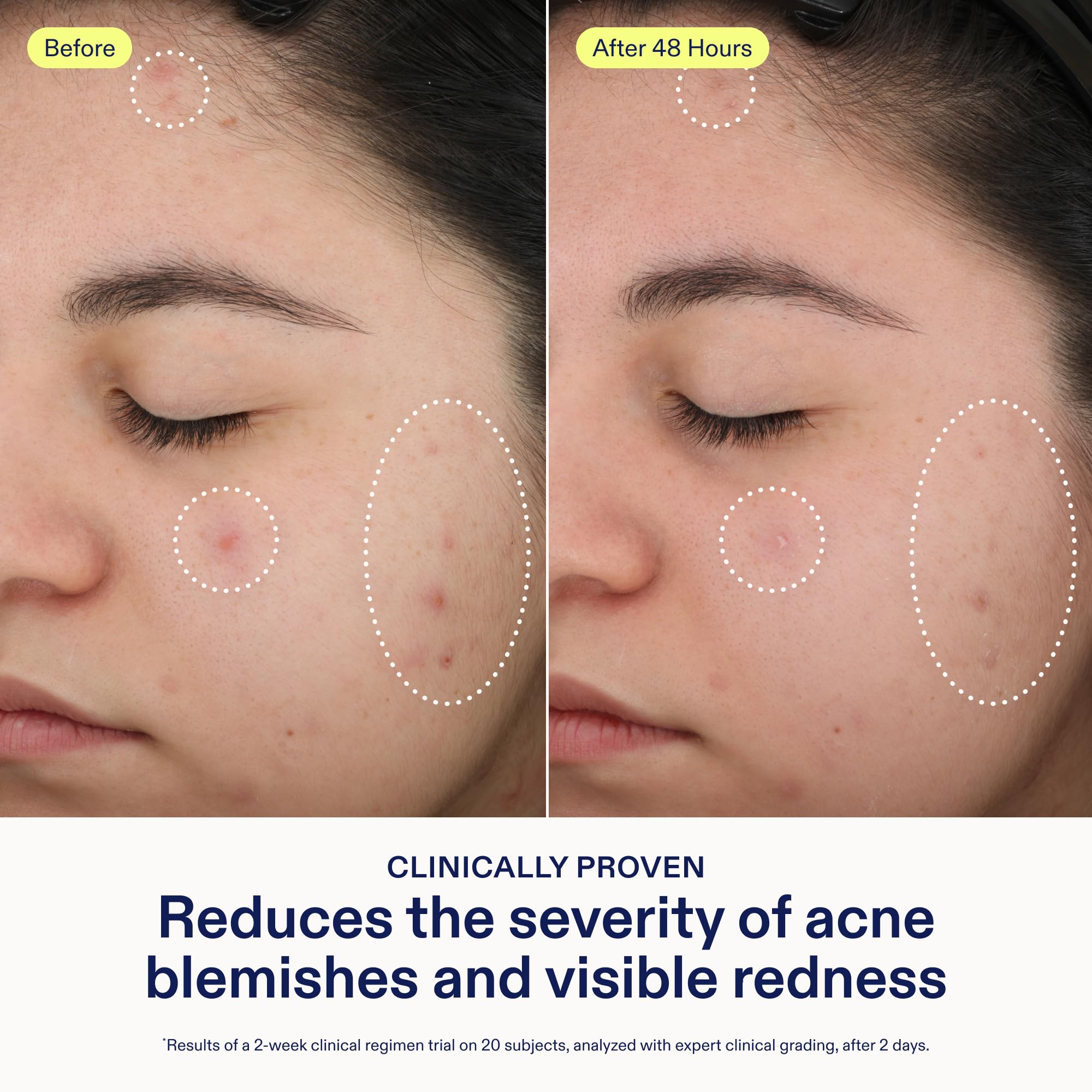 Skinfix azelaic-acid formula reduces redness for even tone