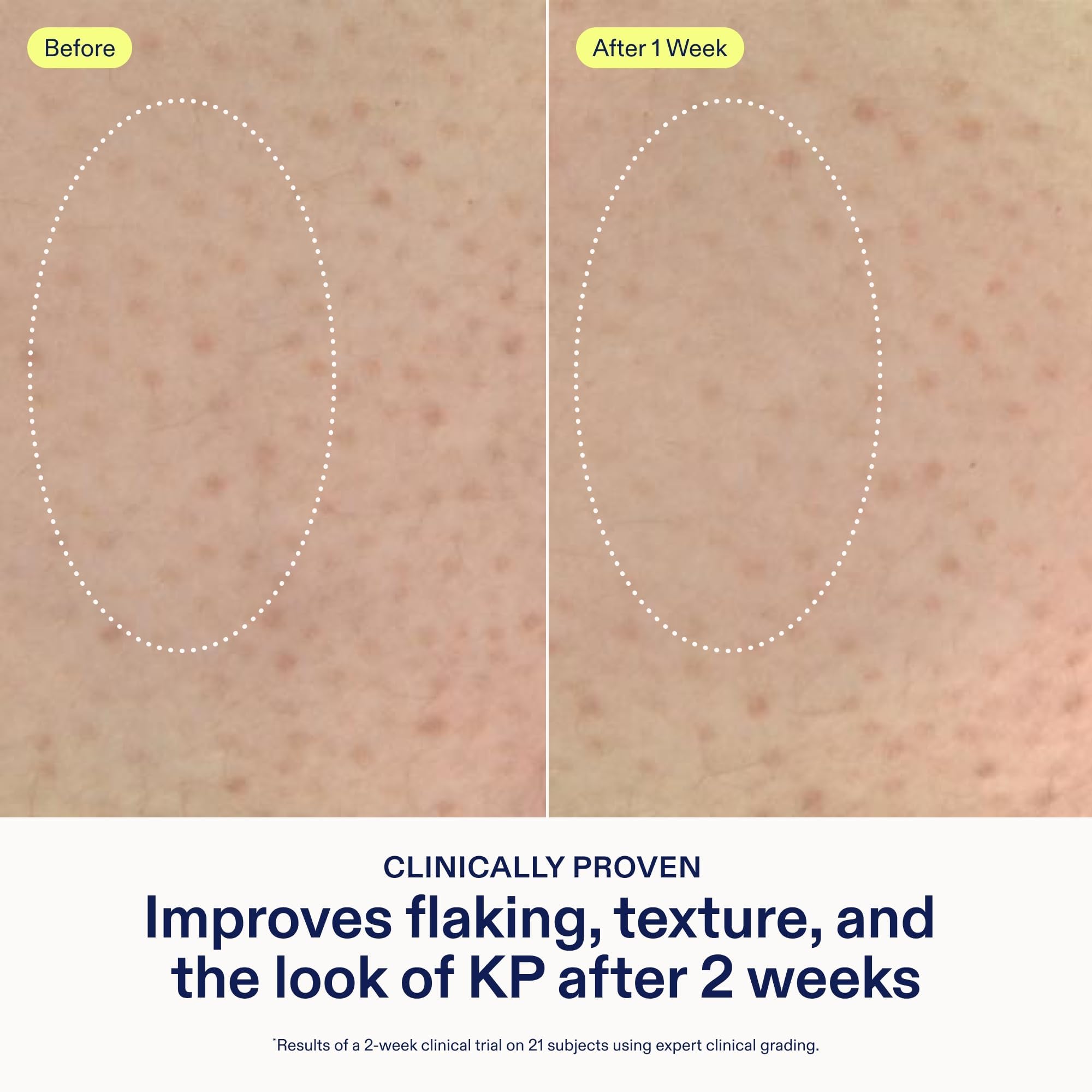 Skinfix KP + PsO Smoothing ingredients label highlights glycolic, lactic, and salicylic acids.