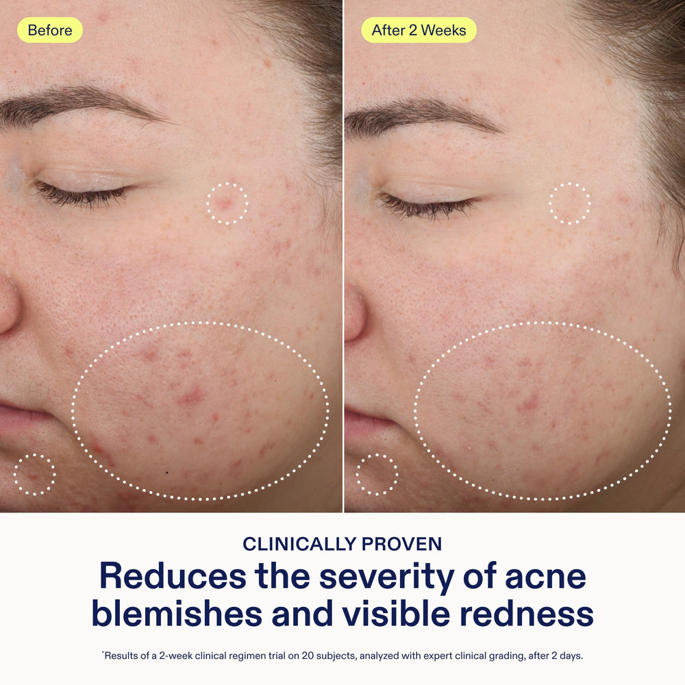 Skinfix salicylic-acid formula clears blemishes and blackheads on problem areas