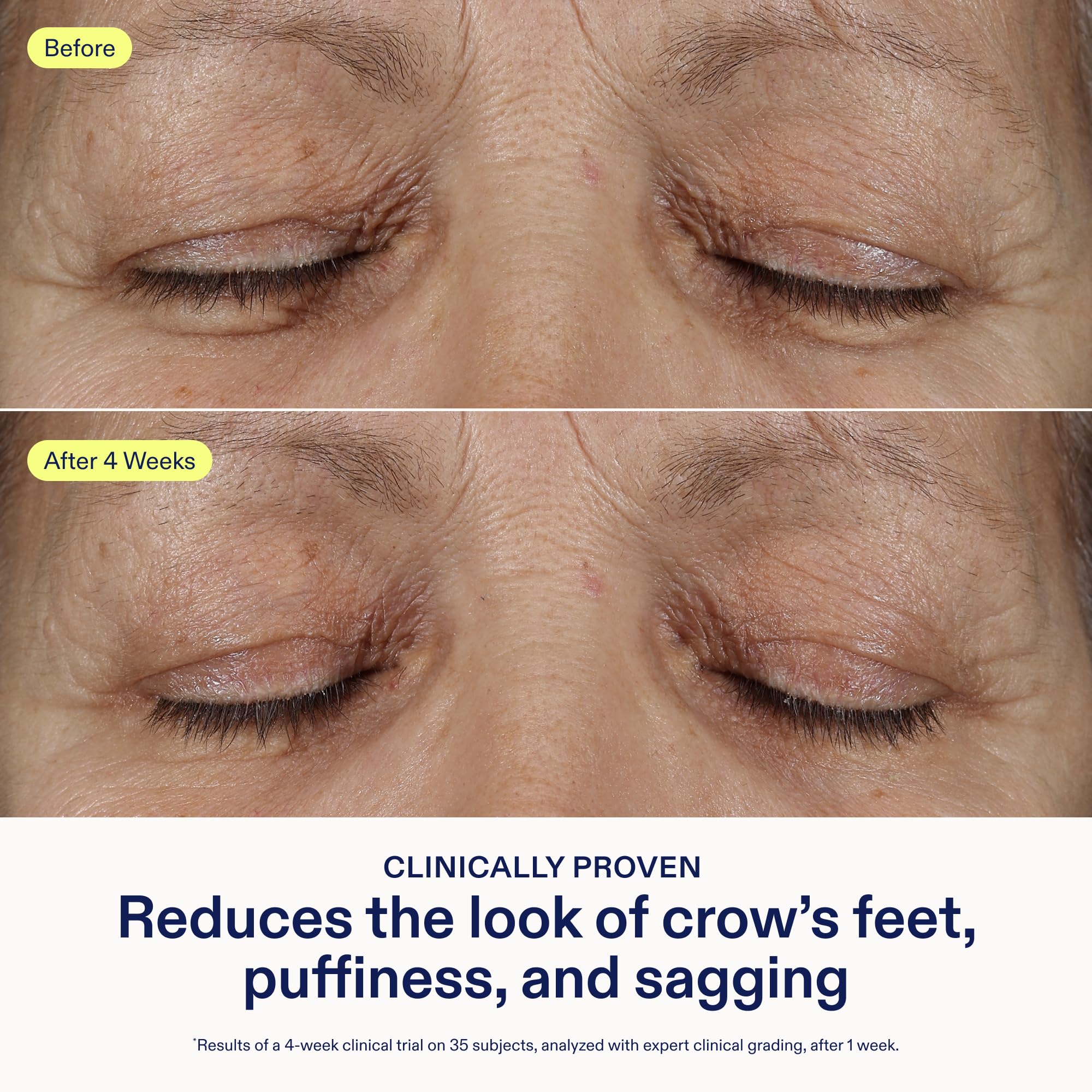Applying Skinfix under-eye treatment to reduce puffiness and support the eye area.