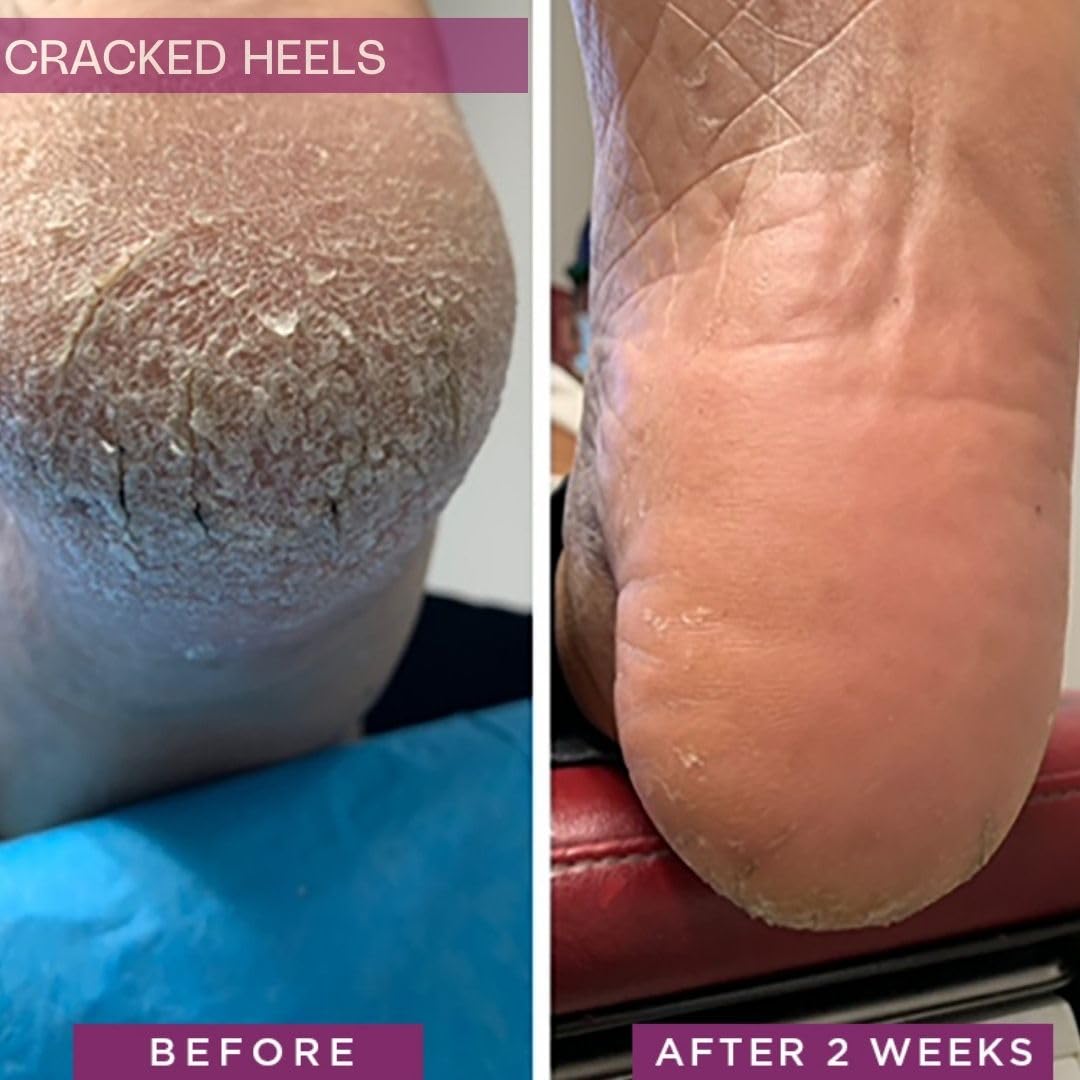 SkinIntegra Rapid Crack Repair Cream for diabetic foot care on a foot image.