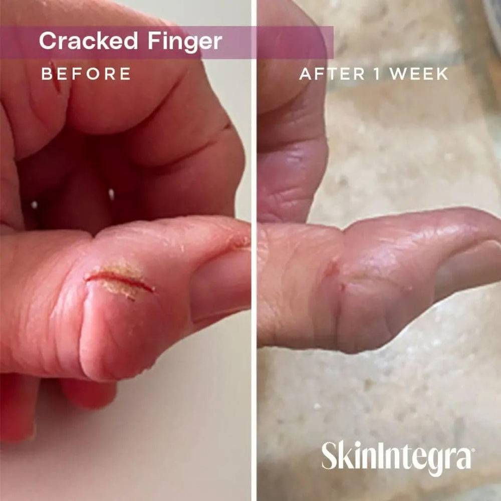SkinIntegra Rapid Crack Repair Cream being applied to the foot for fast-absorbing relief.