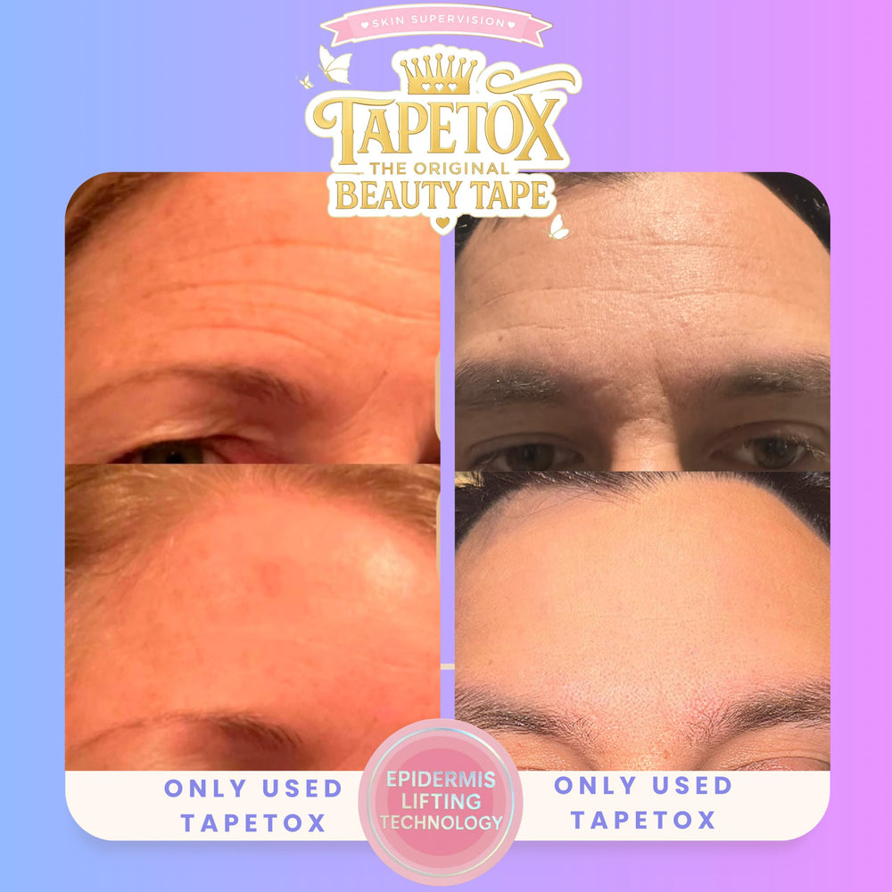 Skin Supervision TapeTox latex-free adhesive enables secure yet gentle removal.