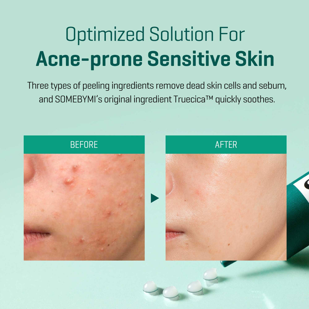 SOME BY MI spot-cream application on cheek demonstrates precise spot treatment.