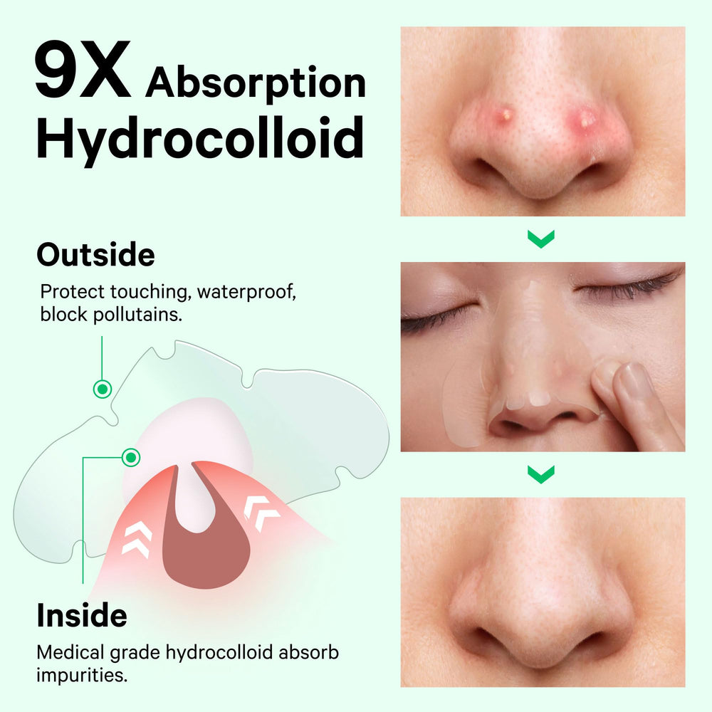 Sosky Nose Patches four-hour effect on pores and blemishes.