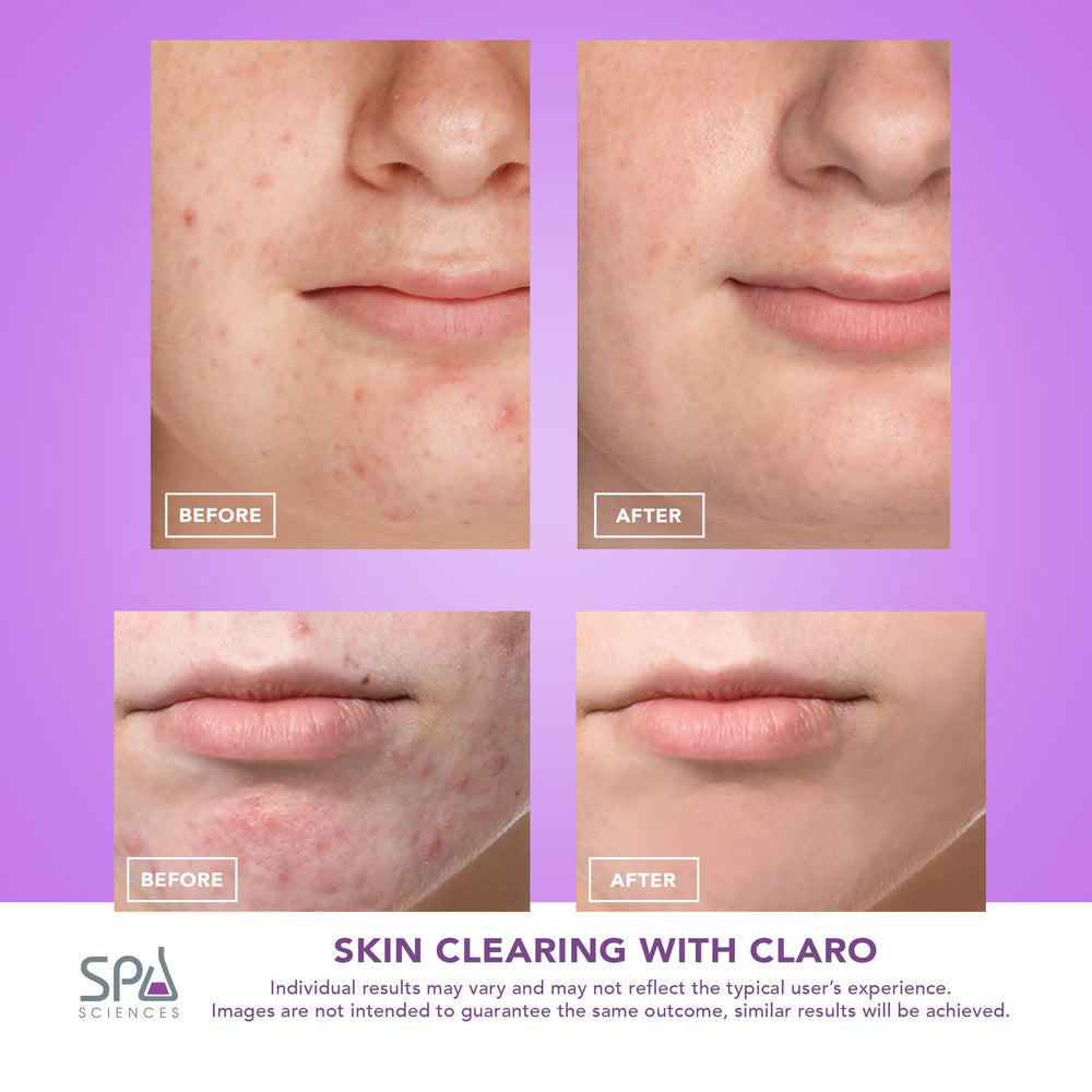 Spa Sciences CLARO FDA-cleared badge - trusted, safe acne therapy.