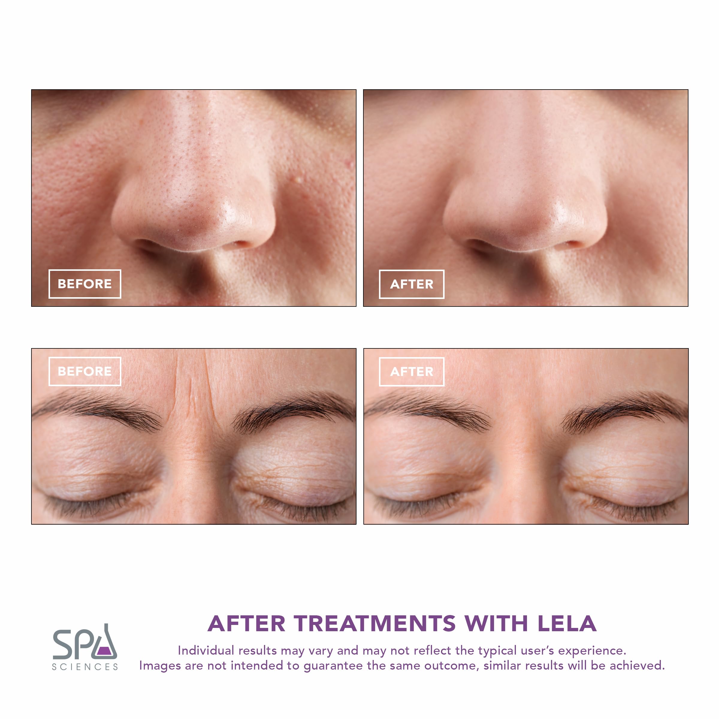 Spa Sciences LELA pore extraction demonstrates gentle purification and refined pores.