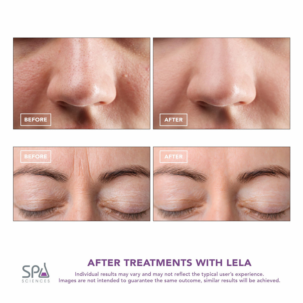 Spa Sciences LELA pore extraction demonstrates gentle purification and refined pores.